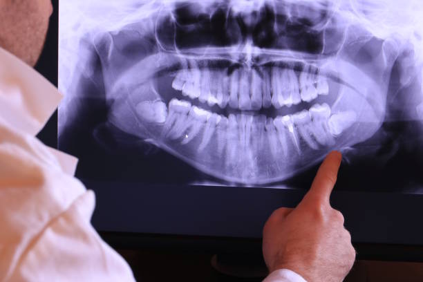 Best Emergency Wisdom Tooth Extraction in Morrison, IL